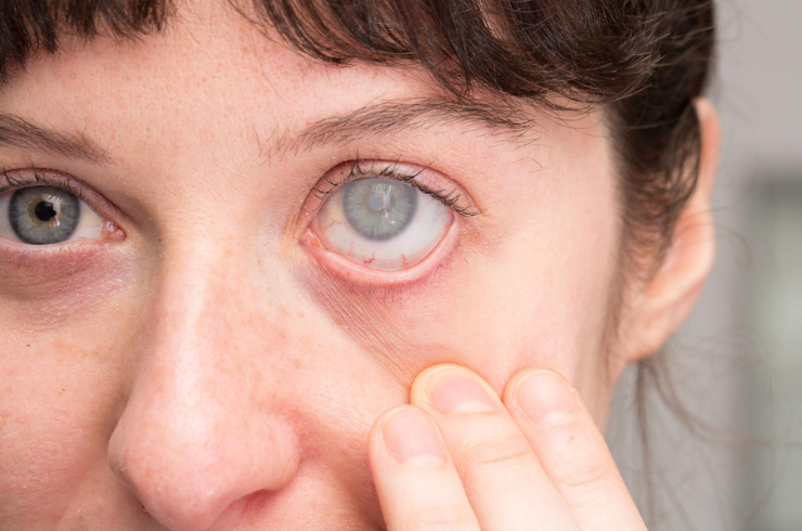 Cataract and Refractive Surgery